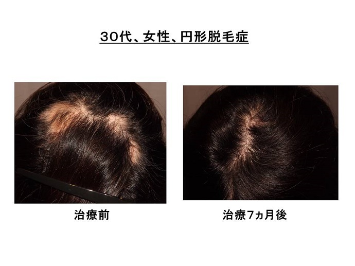 円形脱毛症　病院""